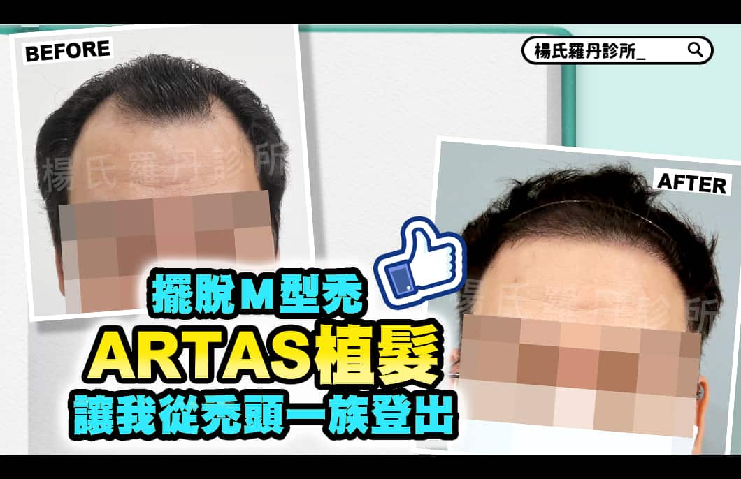 【植髮】擺脫Ｍ型禿  ARTAS植髮讓我從禿頭一族登出